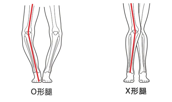 j9九游会干预孩子腿型莫听信“传言”建议科学穿着矫正鞋及鞋垫(图3)